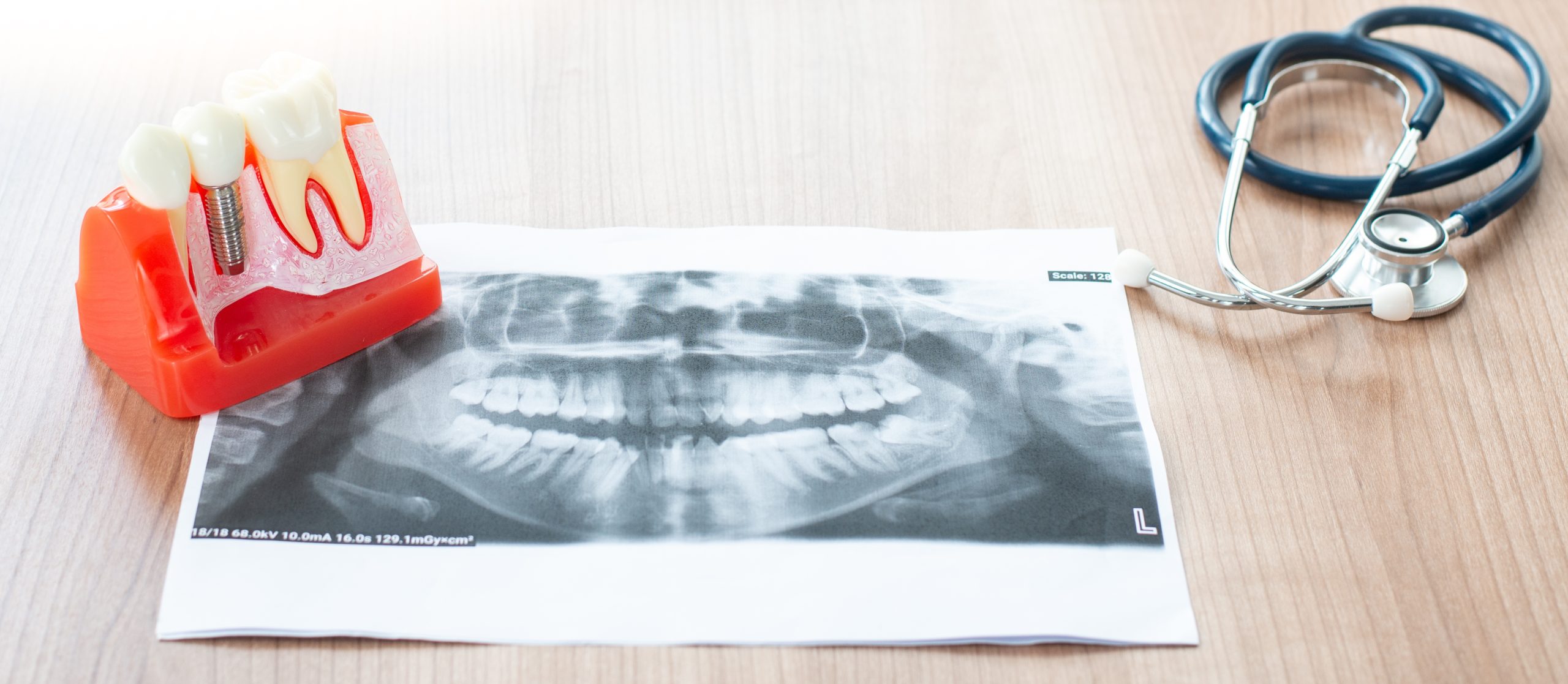 implantes dentales manresa